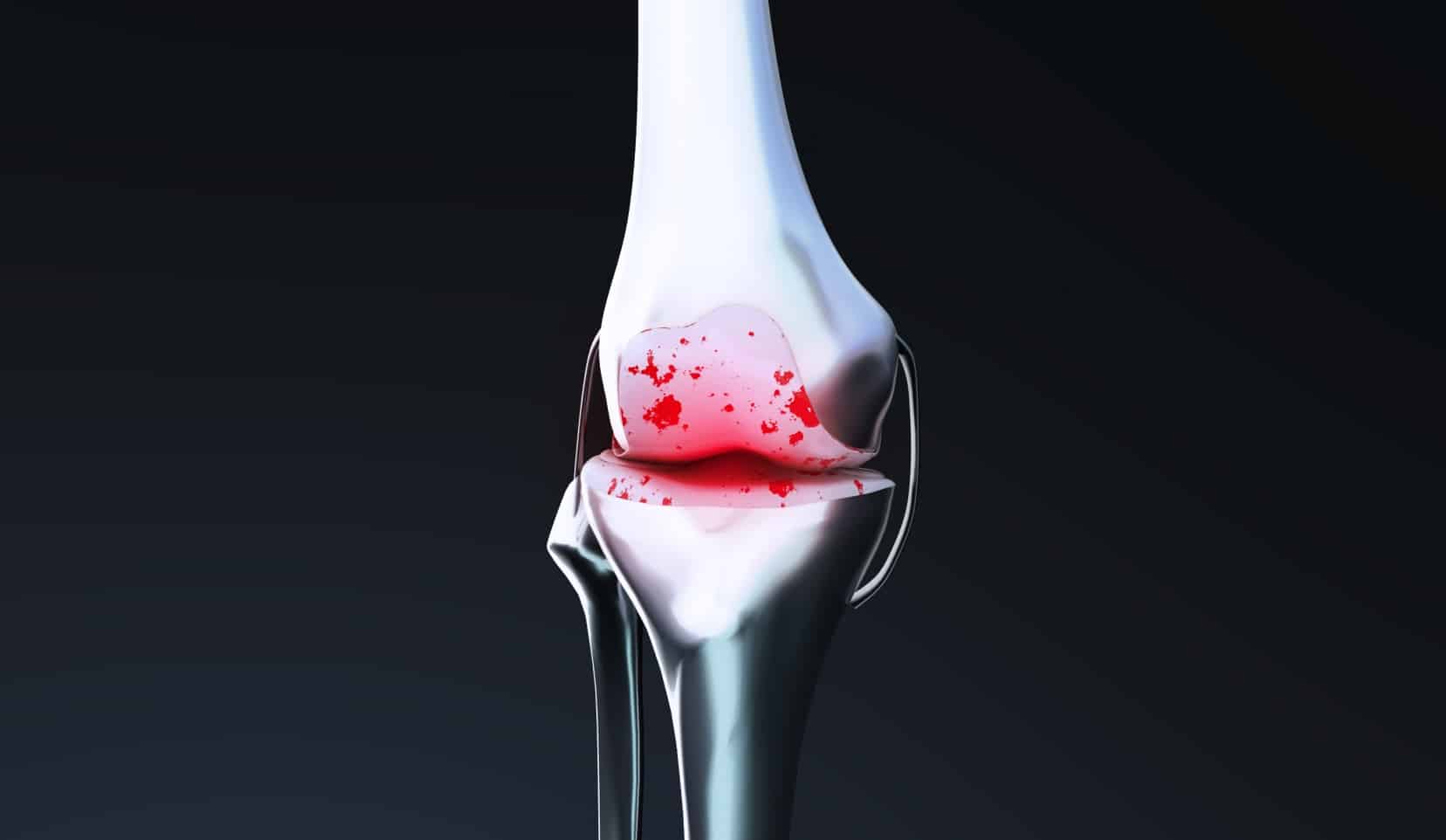 Arthrose du genou : causes et traitements, Dr Polle