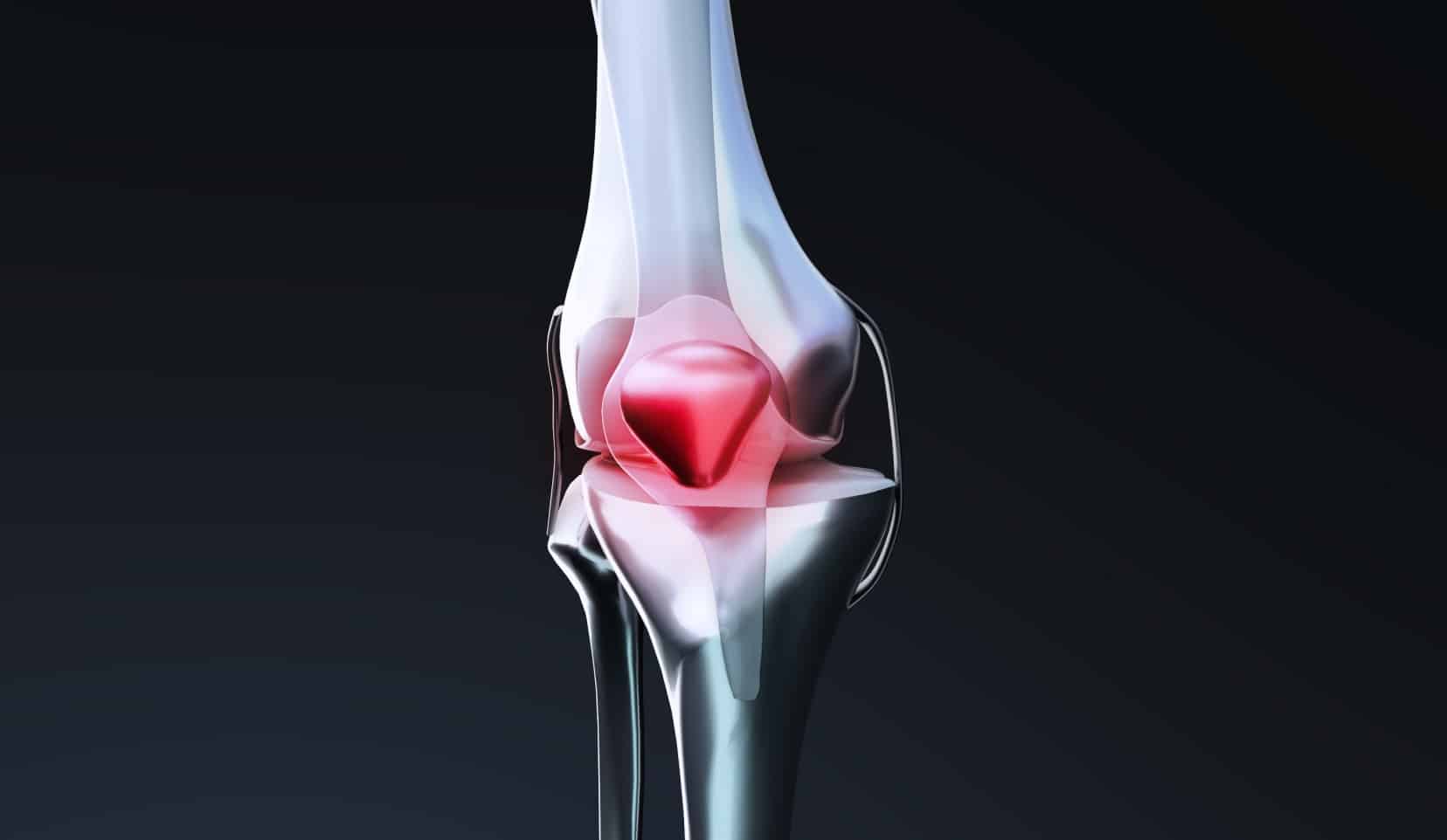 Recentrage rotulien : chirurgie du genou, Bois-Guillaume